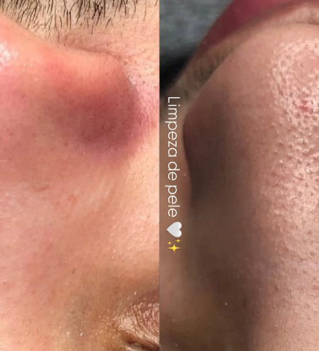 10 - Limpeza de Pele 1