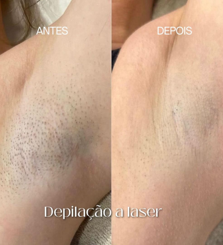 2 - depilação a laser axilas 1