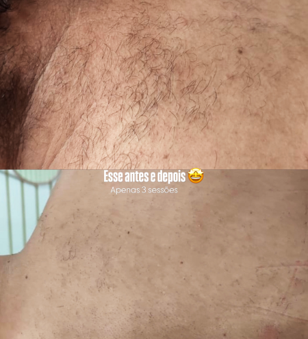4 - Depilação a Laser nas Costas 1